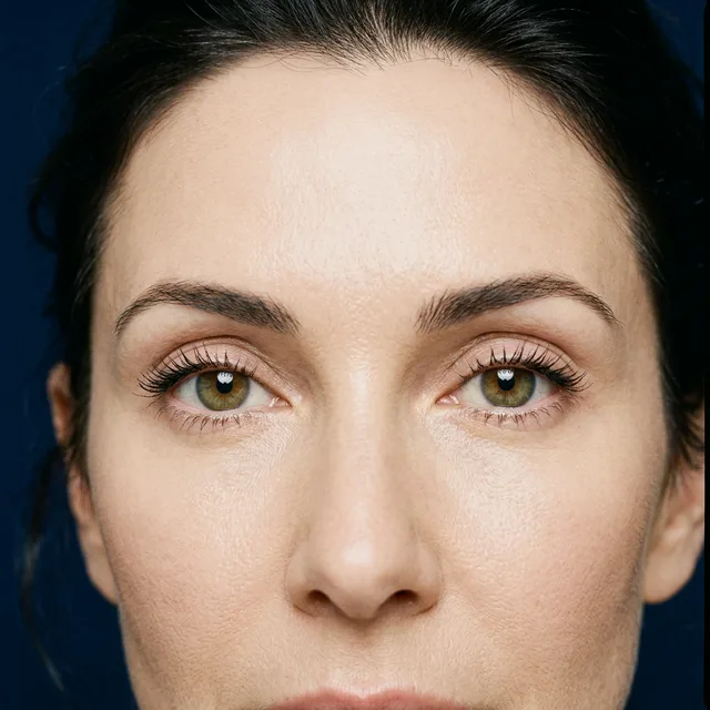 Resultado ilustrativo de blefaroplastia